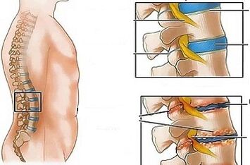 Die Gründe für die Entwicklung der lumbalen Osteochondrose