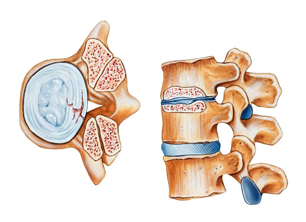 Osteochondrose der Gebärmutterhalsregion führt zur Zerstörung der Bandscheiben der Zwischeneberh