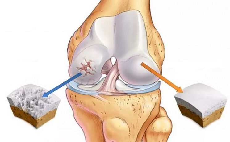 Gesunder Knorpel und Arthrose des Gelenks
