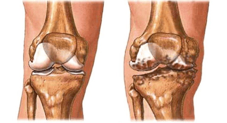 Gesundes Gelenk und Arthrose des Kniegelenks