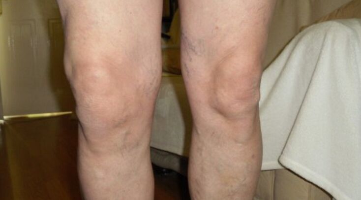 Manifestationen der Arthrose des Kniegelenks