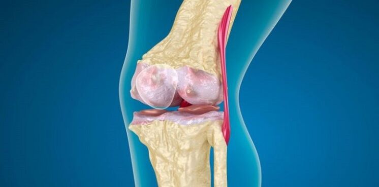 Schädigung des Kniegelenks für Arthrose