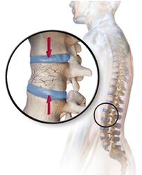 Osteoporose provoziert Rückenschmerzen im unteren Rücken