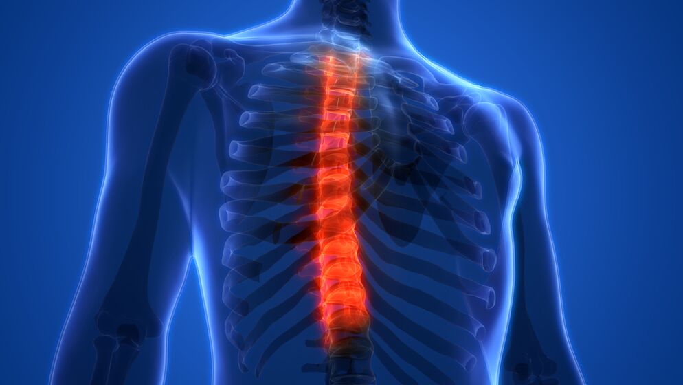 Osteochondrose der Brustwirbelsäule