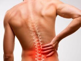 Schmerzen im unteren Rücken aufgrund von Osteochondrose